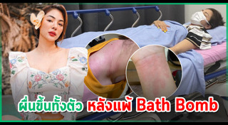 ผื่นคัน