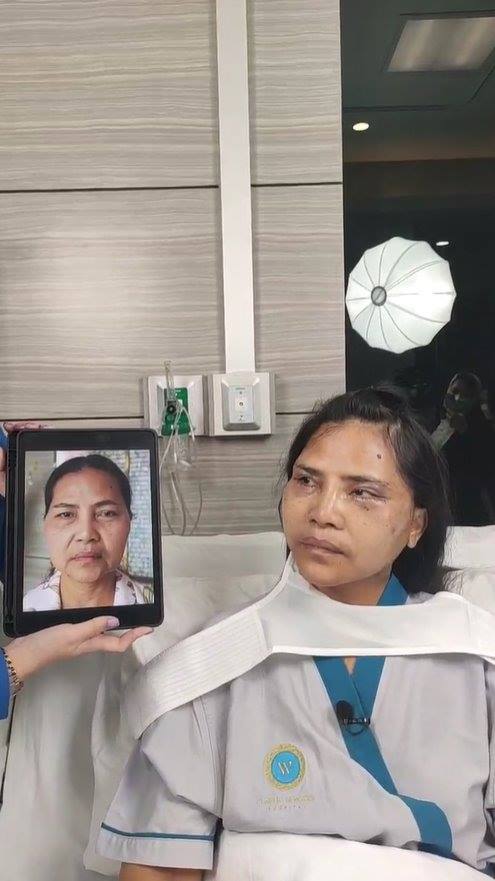 สุนารี ศัลยกรรมหน้า