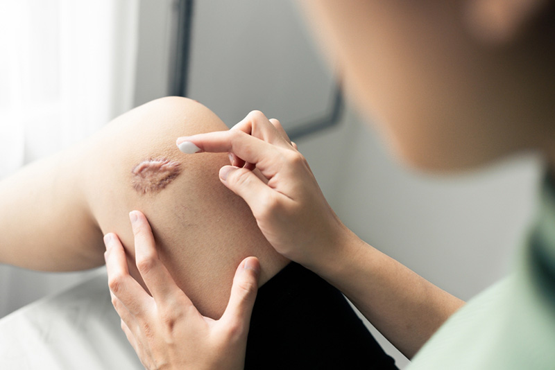 ครีมทาแผลเป็น