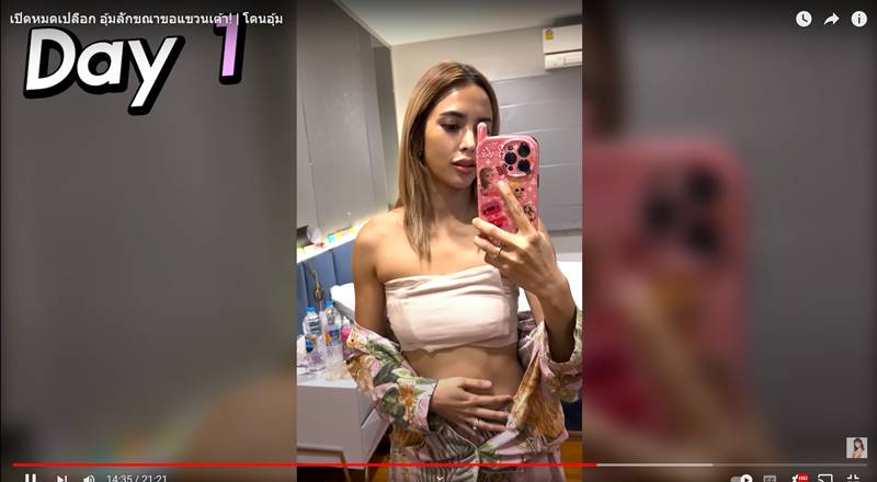 อุ้ม ลักขณา เอาหน้าอกออก 