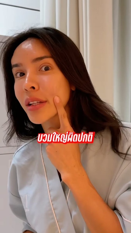 นัท นิสามณี หน้าบวมจนจำไม่ได้