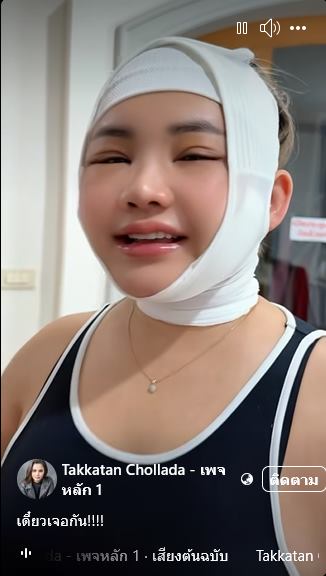 ตั๊กแตน ชลดา ศัลยกรรมหน้า