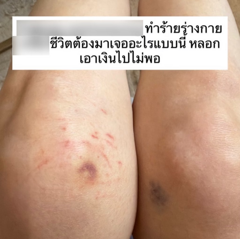 อินฟลูฯ สาว แฉ ถูกดาราดังทำร้ายร่างกาย
