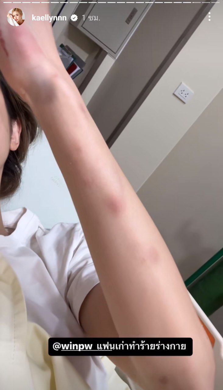 แฟนเก่าทำร้ายร่างกาย