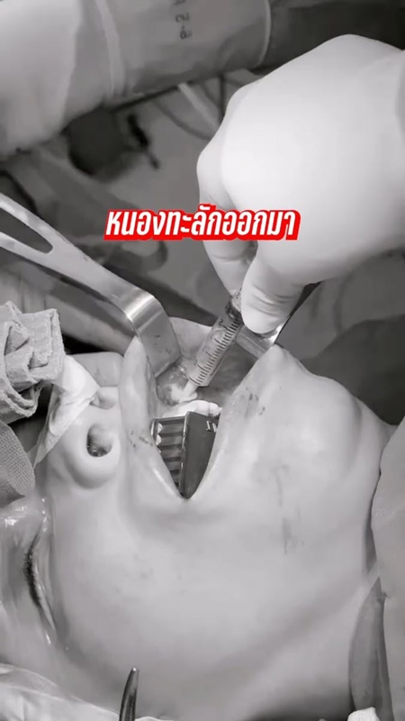 นัท นิสามณี หน้าบวมจนจำไม่ได้