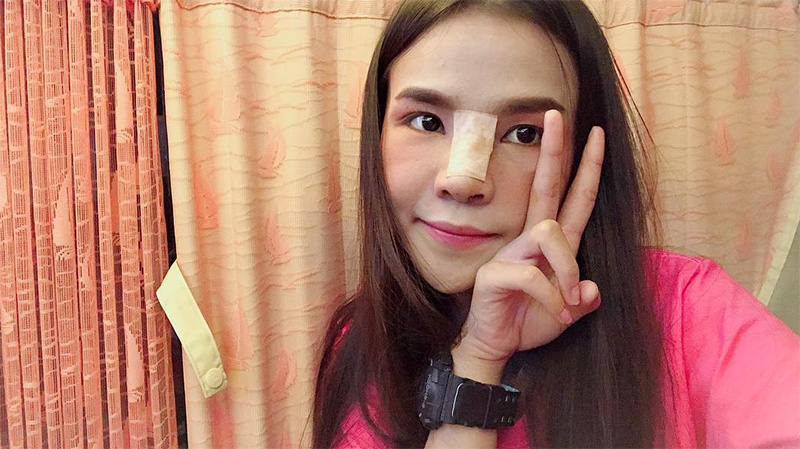 อาม ชุติมา ศัลยกรรมอะไรมาบ้าง เปิดภาพหน้าเก่า VS หน้าใหม่