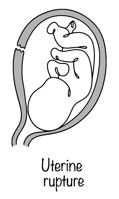 มดลูกแตกขณะตั้งครรภ์