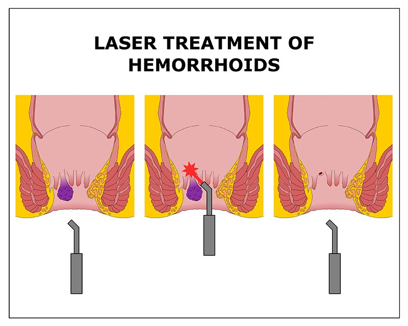 รักษาริดสีดวงทวารด้วยเลเซอร์