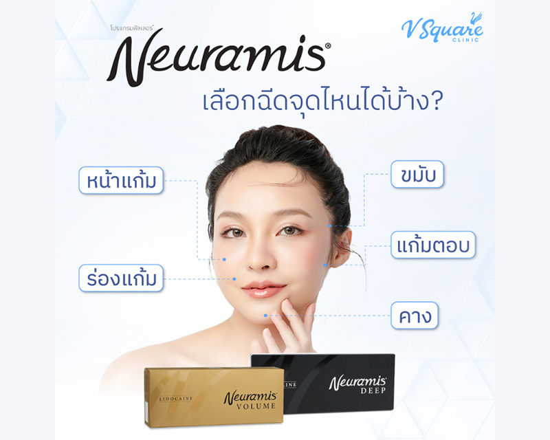 ตำแหน่งฉีด Neuramis
