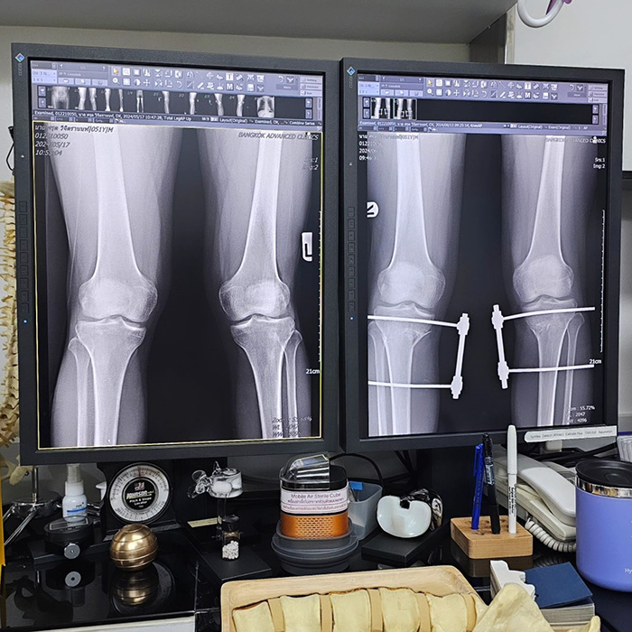 อาการ Knock knee