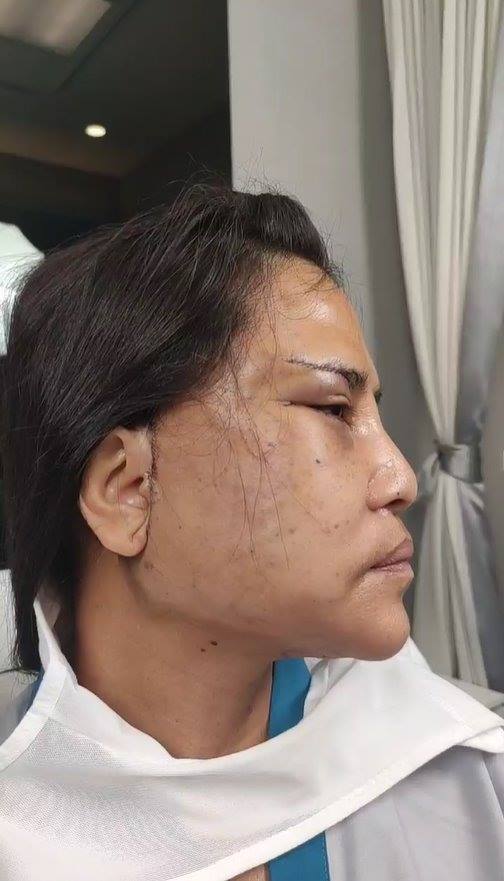 สุนารี ศัลยกรรมหน้า