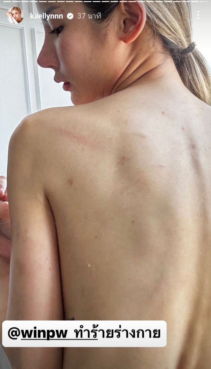 แฟนเก่าทำร้ายร่างกาย