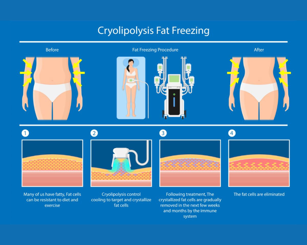 การทำงานสลายไขมันด้วยความเย็น
