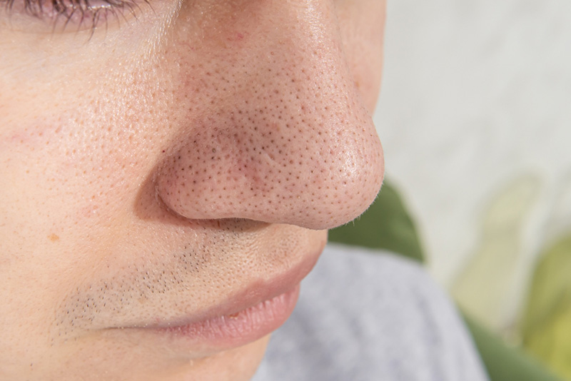 รูขุมขนกว้าง ผู้ชาย