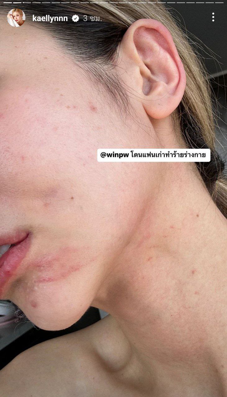 แฟนเก่าทำร้ายร่างกาย