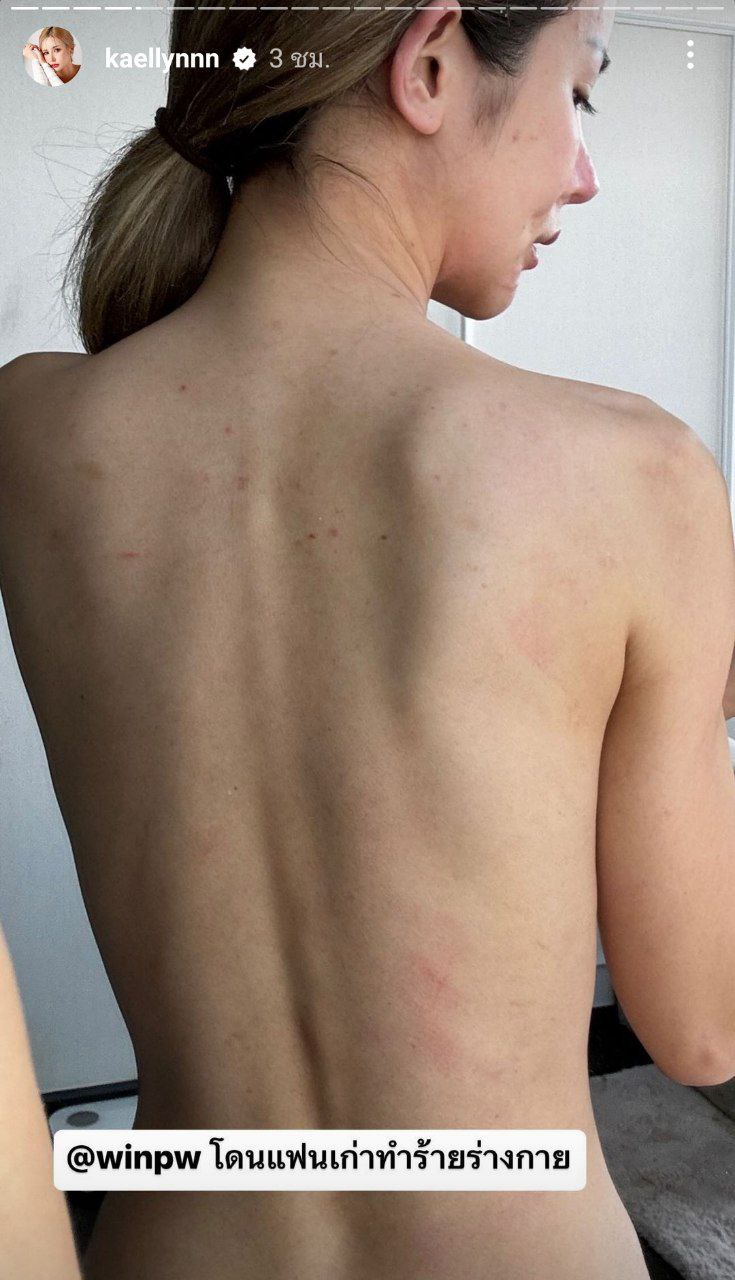 แฟนเก่าทำร้ายร่างกาย