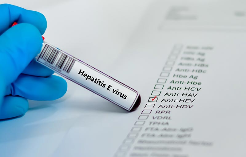 ไวรัสตับอักเสบ อี เกิดจากอะไร