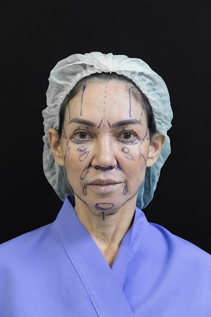 ดี้ ปัทมา ศัลยกรรมหน้า