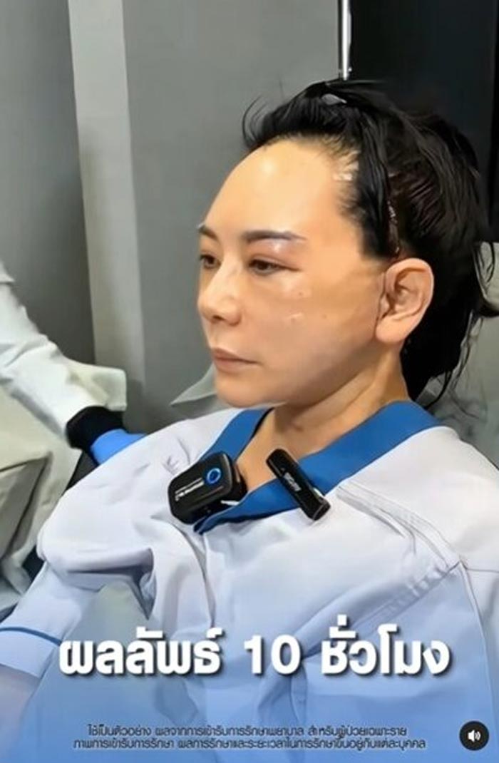 แหม่ม จินตหรา ศัลยกรรม