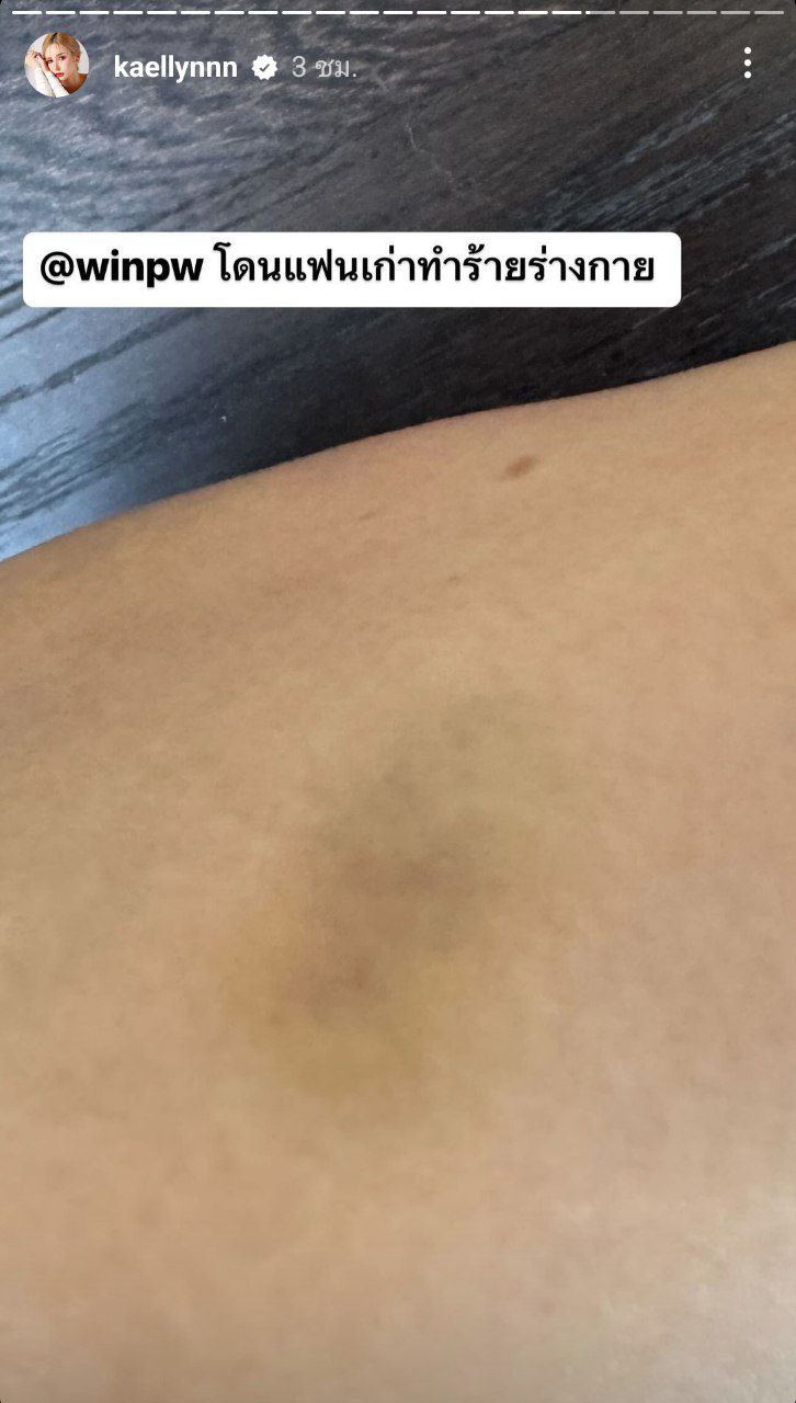 แฟนเก่าทำร้ายร่างกาย