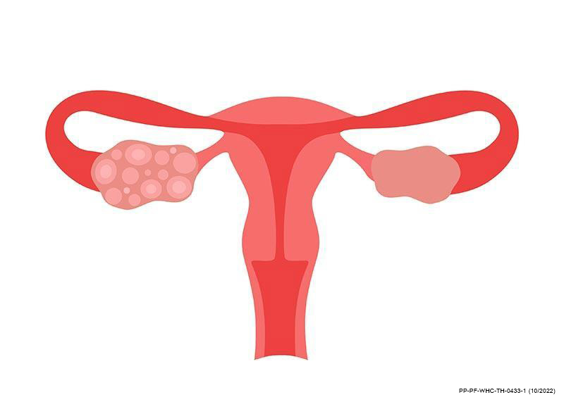 ภาวะ Pcos สิวเห่อ หน้ามัน ขนดก จากถุงน้ำในรังไข่หลายใบที่สาว ๆ เป็นไม่รู้ตัว