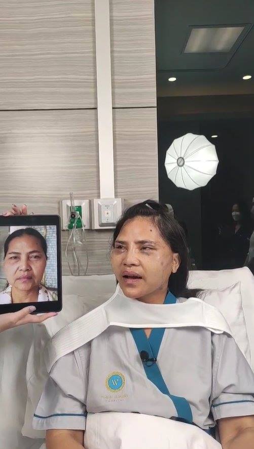 สุนารี ศัลยกรรมหน้า