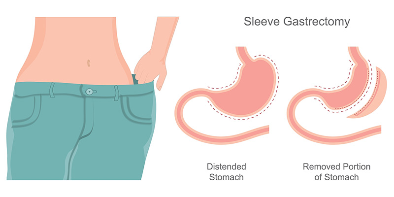 ผ่าตัดลดขนาดกระเพาะอาหารแบบสลีฟ