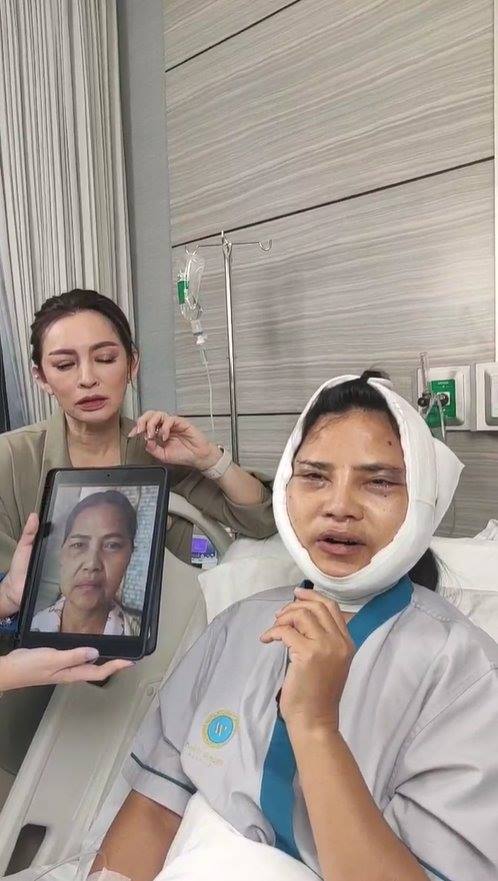 สุนารี ศัลยกรรมหน้า