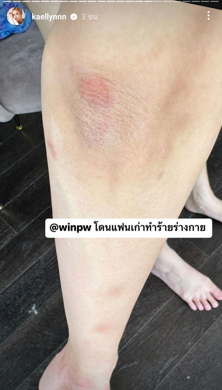 แฟนเก่าทำร้ายร่างกาย