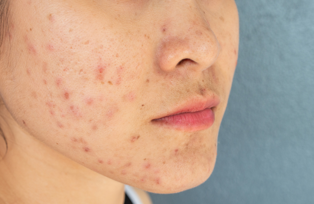 หน้าเป็นหลุมสิวใช้อะไรดี