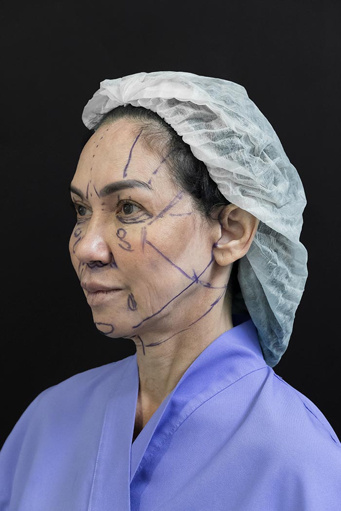 ดี้ ปัทมา ศัลยกรรมหน้า