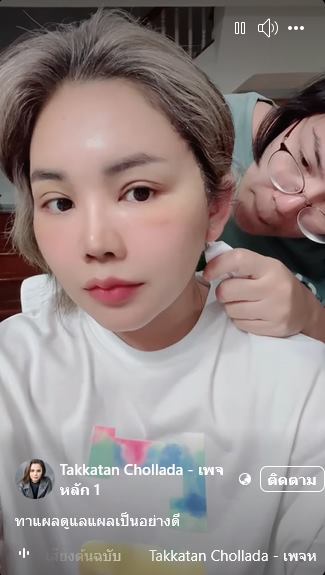 ตั๊กแตน ชลดา ศัลยกรรมหน้า