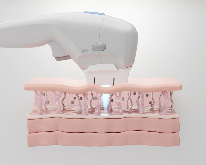 พลังงาน HIFU