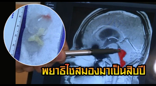 พยาธิไชสมอง