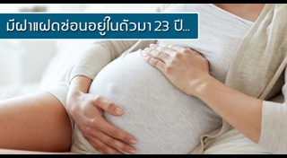 แฝดปรสิต