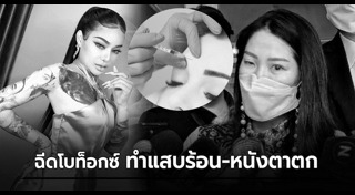 โบท็อกซ์