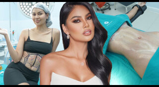 ดูดไขมัน