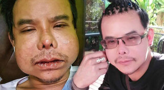 ศัลยกรรมหน้าพัง