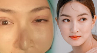 ศัลยกรรมตา