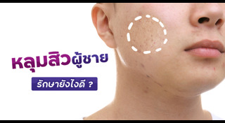 วิธีรักษาหลุมสิว