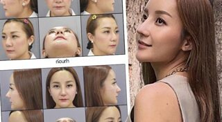 ดาราศัลยกรรมจมูก