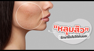 วิธีรักษาหลุมสิว