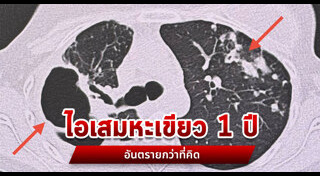 วัณโรค