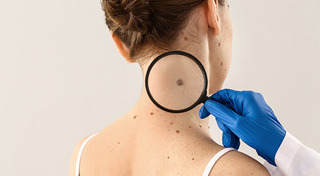 ผิวหนังอักเสบ