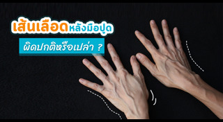 เส้นเลือดขอด