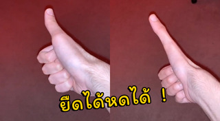 นิ้วผิดปกติ