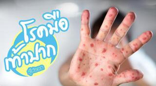 โรคมือเท้าปาก