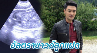 อัลตราซาวด์