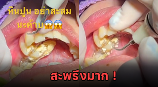 ขูดหินปูน