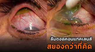 คอนแทคเลนส์